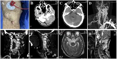 New aneurysm formation after endovascular embolization of a vertebral epidural AV fistula: a rare sequelae of NF AV fistulae